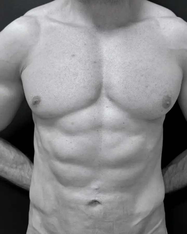 Depois, caso 4 · frente